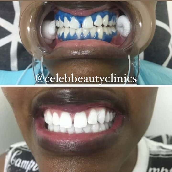 Teeth Whitening