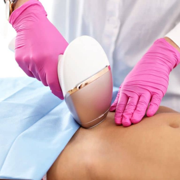 Laser Hair Removal